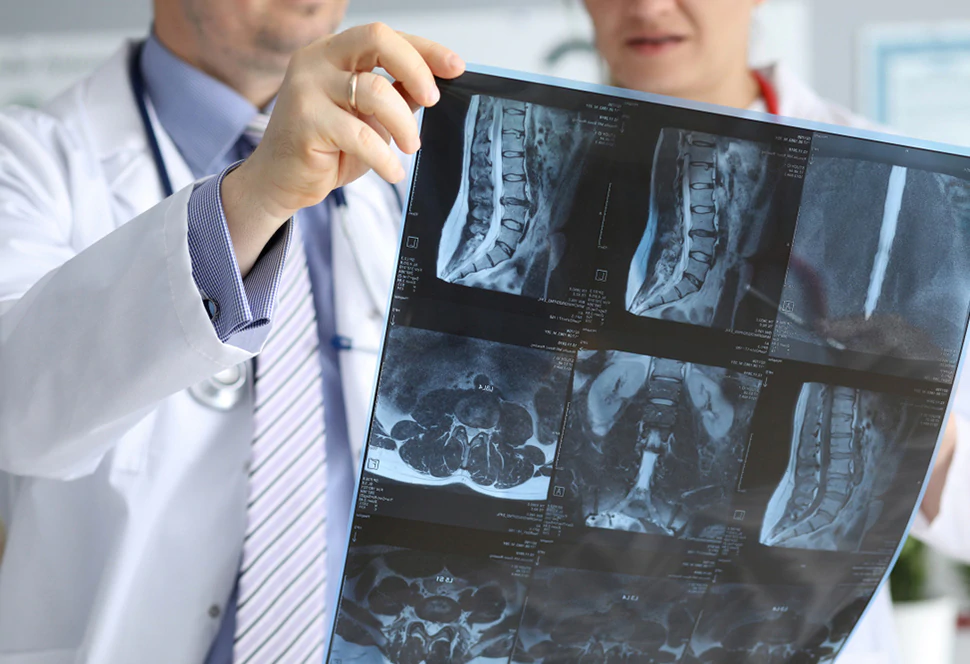Spinal Injuries – MRI Is not enough