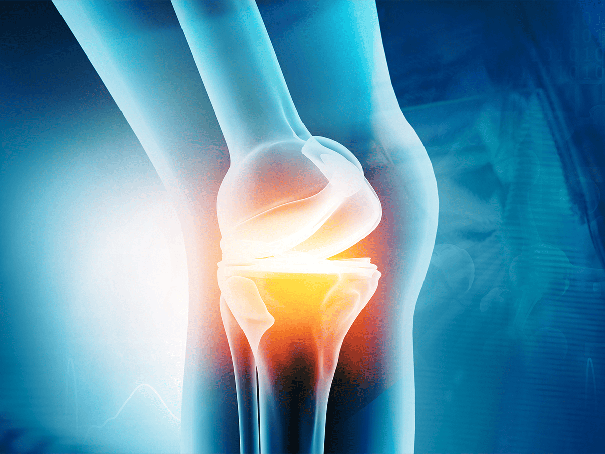 Hyaluronic Acid Injections for Torn Meniscus