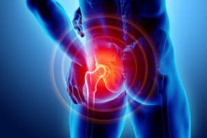 Treatment for Hip Arthritis without Surgery