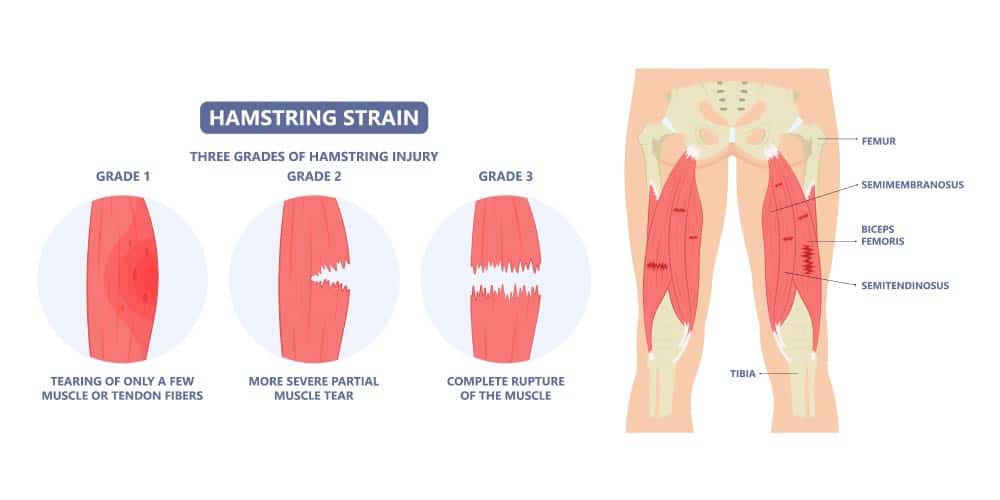 The Various Grades of Hamstring Tears
