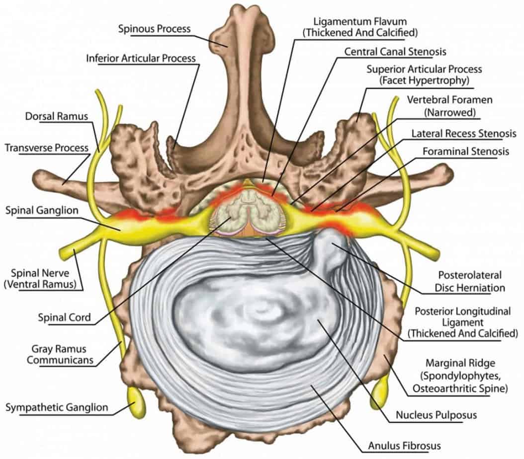 Recurrent Lumbar Disc Herniation