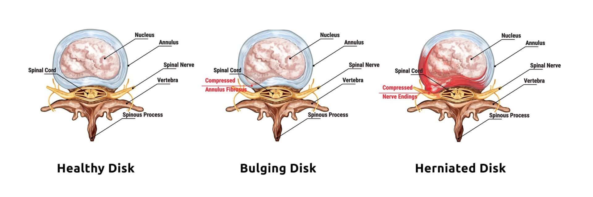 How Long Does it Take for a Chiropractor to Fix a Bulging Disc